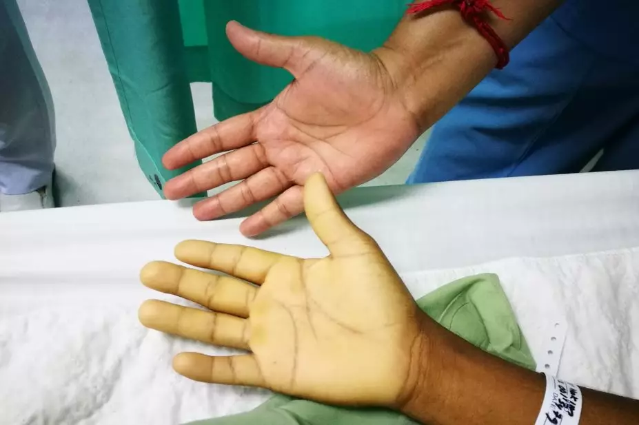 Understanding Anemia: Causes, Symptoms, and Treatment